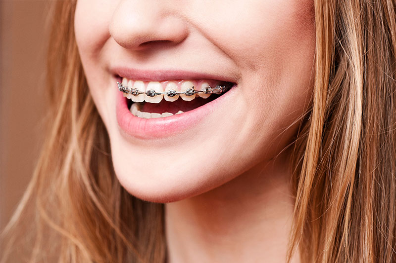 Braces & Orthodontics - High Sierra Dental Care, South Lake Tahoe Dentist